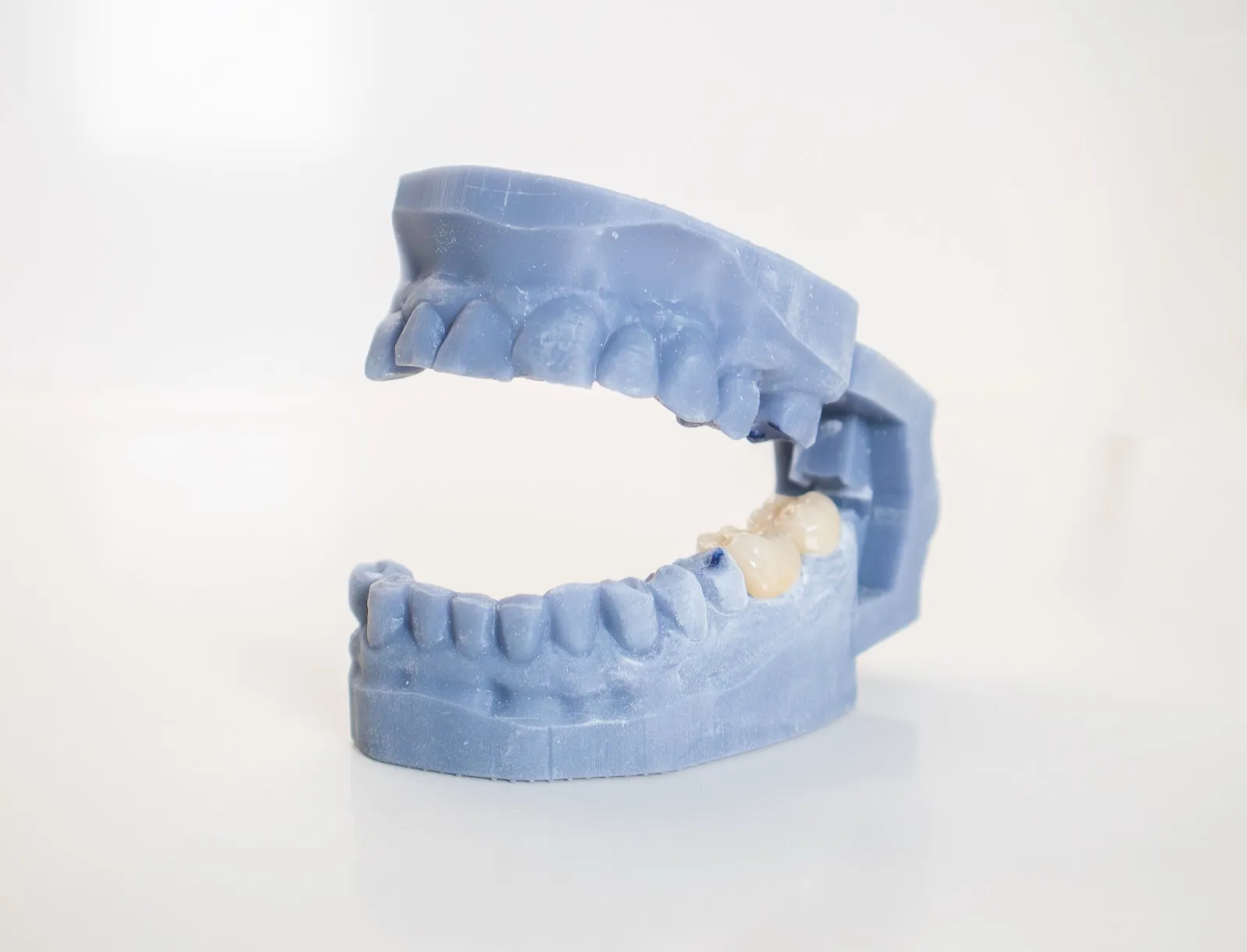 Prótesis en la Clínica Dental Dra. Mª Jesús Crespo